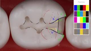 Class II Amalgam 19 MO Acadental  Amalgam Preparation Technique [upl. by Notsua]