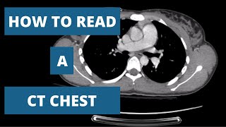 How to Read a CT Scan Chest  A Radiologists Approach [upl. by Yrrek]