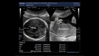 Ultrasound Video showing a case of pregnancy with Polyhydramnios [upl. by Ytiak23]