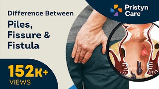 Difference Between Piles Fissure and Fistula  Call Now  9821388242 [upl. by Krenn75]