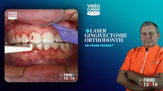 Laser gingivectomie orthodontie  Dr Pourrat [upl. by Pubilis]