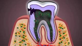 What is Pulpitis [upl. by Etnahsal]