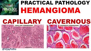 HEMANGIOMA capillary amp Cavernous Clinical features amp Morphology [upl. by Nyleek]