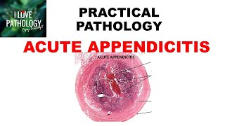 ACUTE APPENDICITIS Etiopathogenesis clinical features amp morphology [upl. by Humbert]