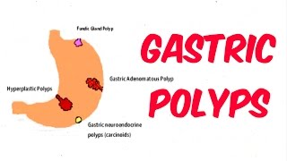 Gastric Stomach Polyps [upl. by Hepsoj]