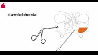 Nasennebenhöhlen OP  FESS  chronische Sinusitis [upl. by Tremaine]
