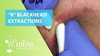 quotKquot Blackhead Extractions [upl. by Decker94]