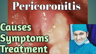 Pericoronitis Types Causes Signs Symptoms Treatments [upl. by Htebazie]