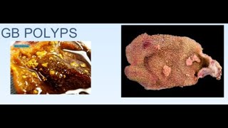 Gallbladder Polyps  What to do with them  Dr H V Shivaram [upl. by Hanny745]