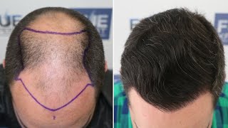 Best Hair Transplant Repair 11500 Grafts Norwood 7 Hair Redemption [upl. by Okajima]