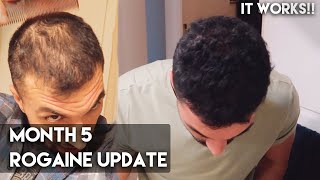 5 Month Rogaine Update Minoxidil  IT WORKS [upl. by Hessney]