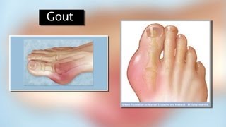 Gout and Turmeric [upl. by Yltnerb]