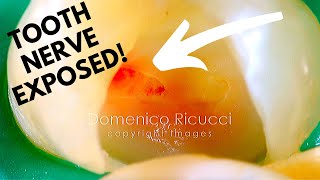 Tooth Cavity  Partial Pulpotomy 2 Healed Without a Root Canal  Dr Ricucci [upl. by Jobie566]