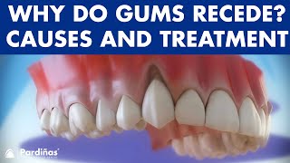 Gum recession  Treatment of gingival retraction © [upl. by Casta]