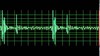 Normal Heart Sound slow [upl. by Schwenk789]