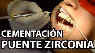 Cementación Puente Zirconia 6 Unidades👅Parte2 [upl. by Schreck820]