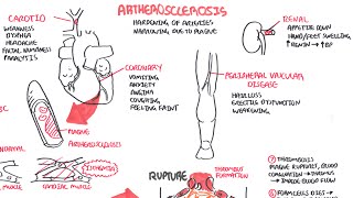 Atherosclerosis  Pathophysiology [upl. by Kelli]