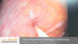 Colon Polyp Removal During Colonoscopy  Los Angeles La Peer Surgery Center [upl. by Ytirahc]