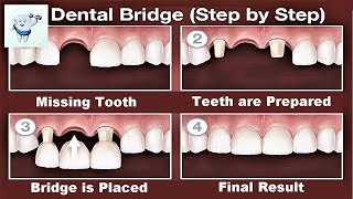 Dental Bridge Procedure Step by Step [upl. by Anotal95]