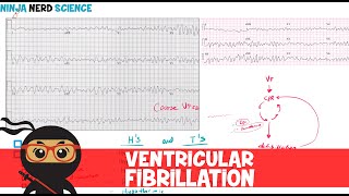 Rate and Rhythm  Ventricular Fibrillation [upl. by Roos]