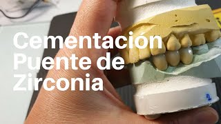 PUENTE de ZIRCONIA👅 Posterior CEMENTACION Puentezirconia Puentedental [upl. by Barcot230]