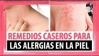 Diagnóstico da dermatite atópica  Dicas de Saúde [upl. by Juline988]