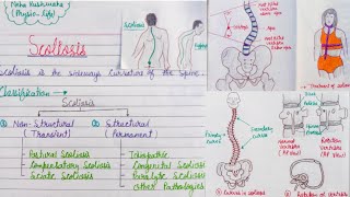 Scoliosis classification pathologydiagnosistreatment [upl. by Oilime812]