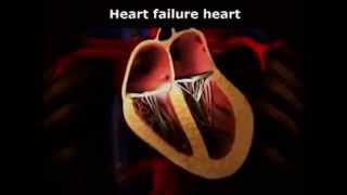 HF1  Healthy to Heart Failure Animation [upl. by Ettegroeg140]