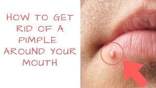 How to get rid of PIMPLES Around your mouth  PrettyBoyFloyd 🌹 [upl. by Yellah890]