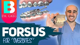 Braces Forsus for Overbite Overjet Correction [upl. by Noivert]