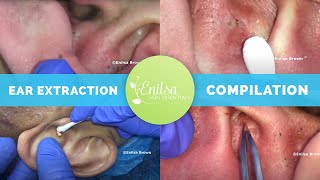 Ear Extraction Compilation [upl. by Hasseman]