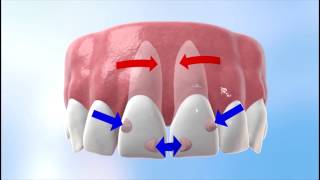 Discover how Invisalign works [upl. by Arul]