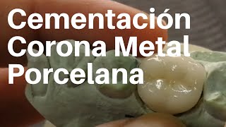 CORONA 👅 METAL PORCELANA Cementación coronadental [upl. by Zeta]