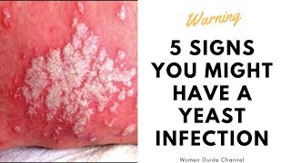 5 Signs You Might Have a Yeast Infection [upl. by Dnarud]