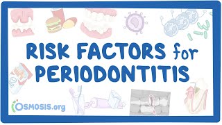 Risk Factors for Periodontitis [upl. by Caplan]