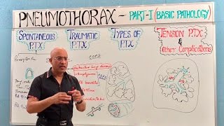 Pneumothorax  Spontaneous Tension amp Traumatic🫁 [upl. by Yrrehc78]