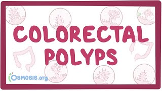 Colorectal polyps  an Osmosis Preview [upl. by Mosora]