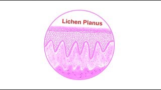 Lichen planus Histopathological features  Lets draw [upl. by Maddy634]