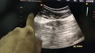 Incisional hernia ultrasound [upl. by Meras802]