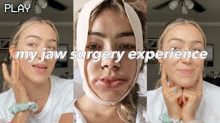 UNDERBITE JAW SURGERY  vlog  recovery days 114  before amp after [upl. by Athalla]