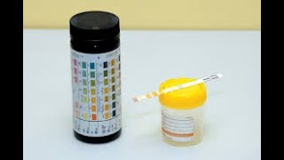 Dipstick Urinalysis Analysis [upl. by Notnel782]