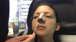 How to clean your nose after rhinoplasty [upl. by Sosna152]