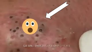 Giant Blackheads removal on face and nose [upl. by Gerrilee]