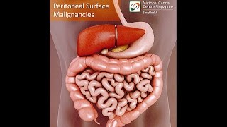 All About Peritoneal Tumours Causes Symptoms Diagnosis and Treatment [upl. by Ednutabab]