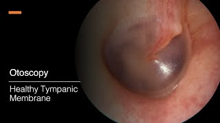 Tympanic Membrane Otosopy [upl. by Yelhsa930]