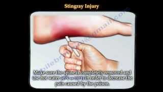 Stingray fish injury  Everything You Need To Know  Dr Nabil Ebraheim [upl. by Eanrahs676]