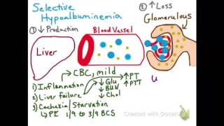 Selective Hypoalbuminemia [upl. by Artema]