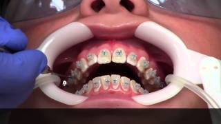 Getting Braces  How [upl. by Suiravat]