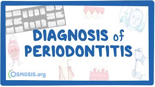 Diagnosis of Periodontitis [upl. by Namlas]