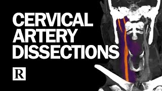 Cervical Arterial Dissections [upl. by Ibocaj]